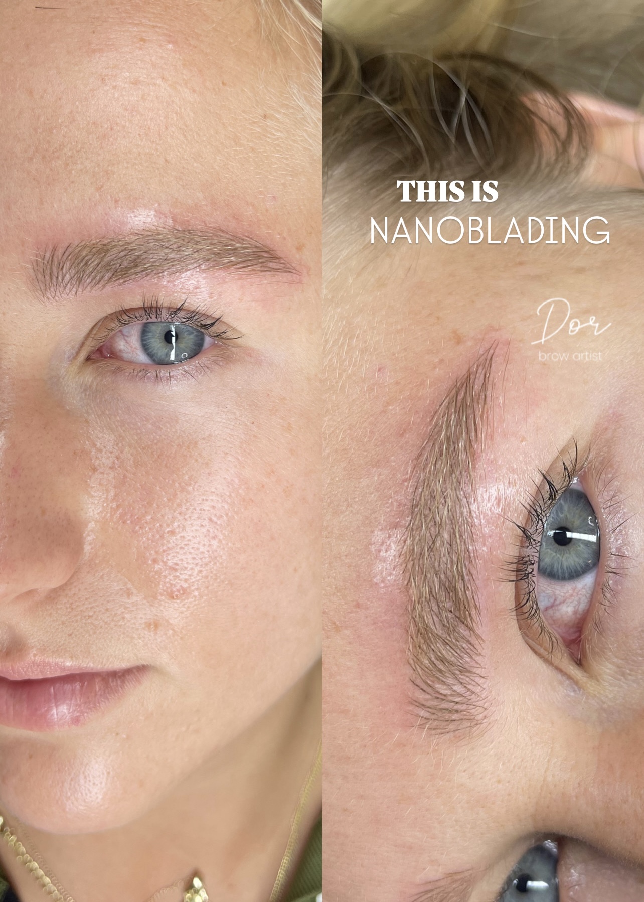 This is Nanoblading